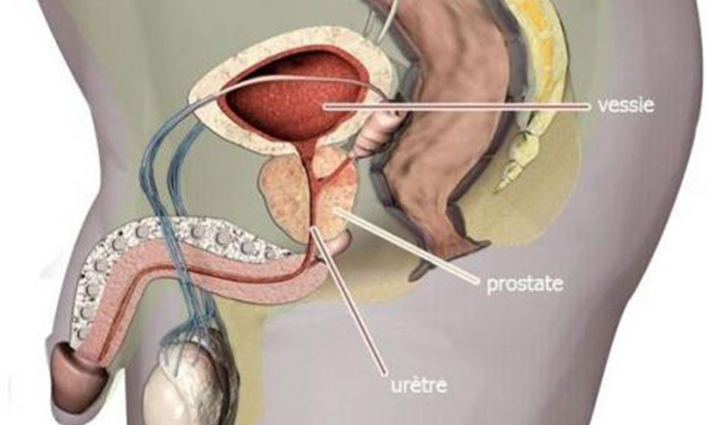 schéma prostate